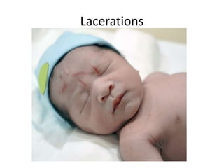 Lacerations
 