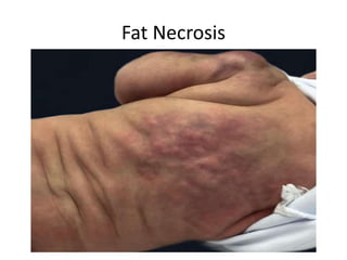 Fat Necrosis
 