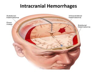 Intracranial Hemorrhages
 