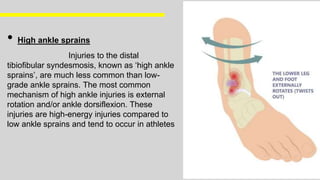 • High ankle sprains
Injuries to the distal
tibiofibular syndesmosis, known as ‘high ankle
sprains’, are much less common than low-
grade ankle sprains. The most common
mechanism of high ankle injuries is external
rotation and/or ankle dorsiflexion. These
injuries are high-energy injuries compared to
low ankle sprains and tend to occur in athletes
 