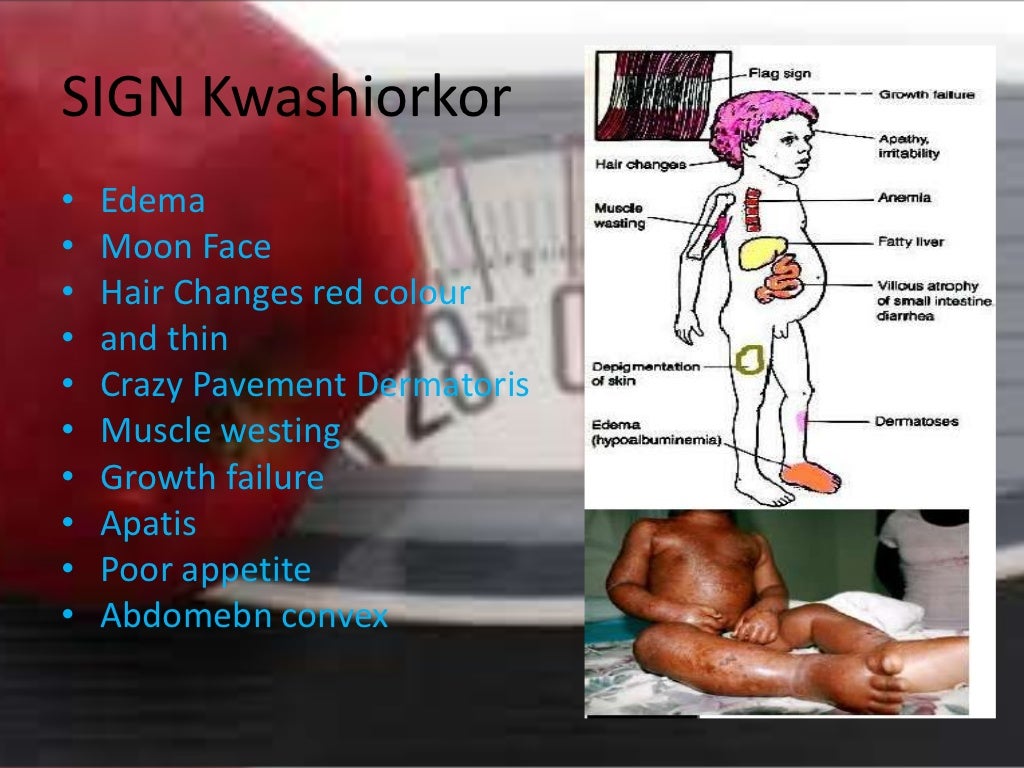 Protein Energy Malnutrition