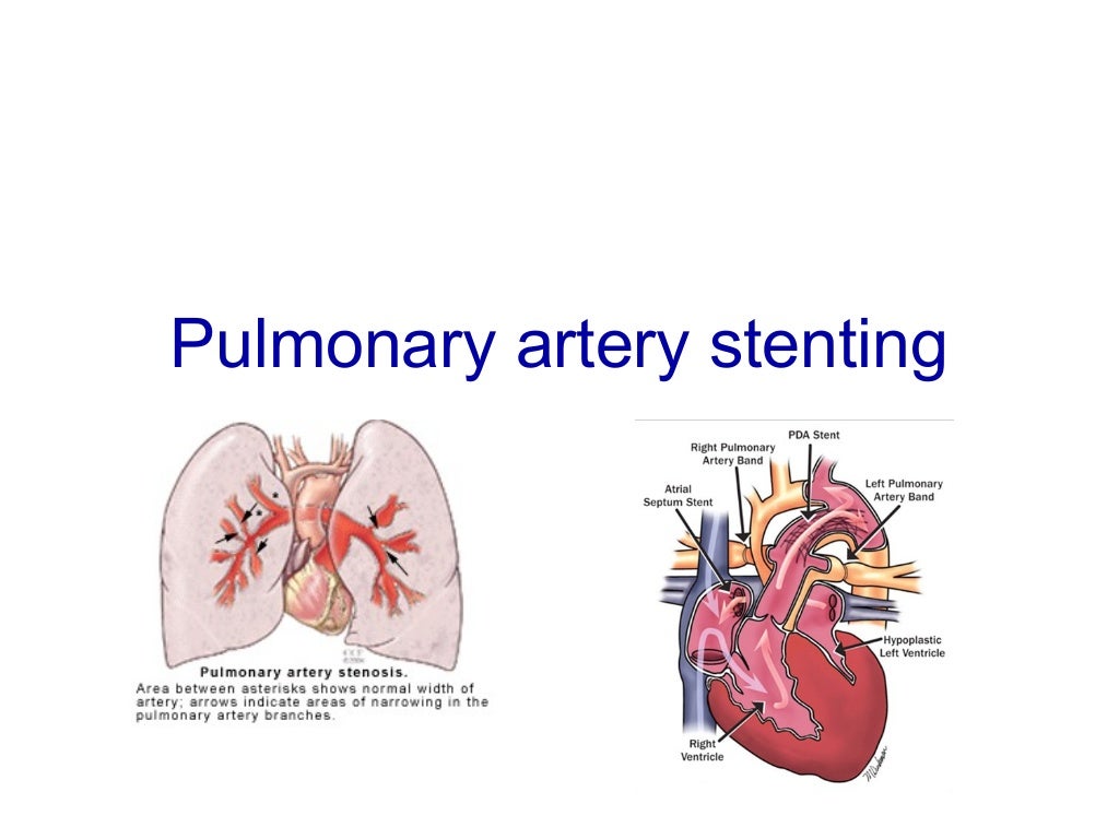 Presentation on heart valve devices