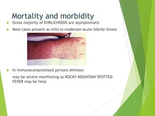 Mortality and morbidity


Great majority of EHRLICHIOSIS are asymptomatic



Most cases present as mild to moderate acute febrile illness



In immunocompromised persons ehrliosis
may be severe manifesting as ROCKY MOUNTAIN SPOTTED
FEVER may be fatal

 