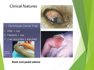 Clinical features

Rash and pedal edema

 
