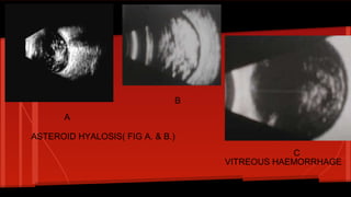 ASTEROID HYALOSIS( FIG A. & B.)
VITREOUS HAEMORRHAGE
A
B
C
 