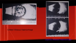 Clotted Vitreous Haemorrhage
Layered Vitreous Haemorrhage
 