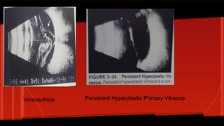 Vitreoschisis Persistent Hyperplastic Primary Vitreous
 