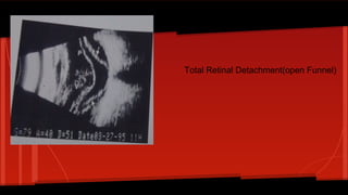 Total Retinal Detachment(open Funnel)
 