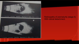 Retinopathy of prematurity (stage 5)
With retinal detachment
 