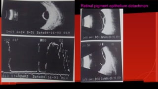 Retinal pigment epithelium detachment
 