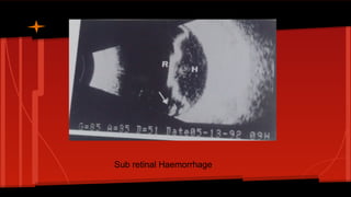 Sub retinal Haemorrhage
 