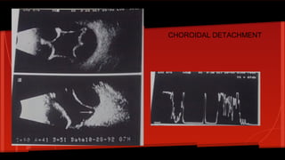 CHOROIDAL DETACHMENT
 