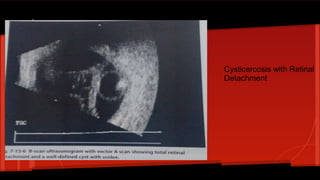 Cysticercosis with Retinal
Detachment
 