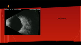 Coloboma
 