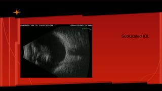 Subluxated IOL
 