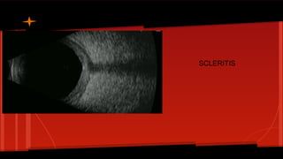 SCLERITIS
 