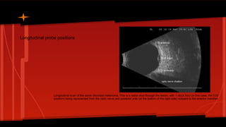 Longitudinal probe positions
Longitudinal scan of the same choroidal melanoma. This is a radial slice through the lesion, with 1 clock hour (in this case, the 5:00
position) being represented from the optic nerve and posterior pole (at the bottom of the right side) outward to the anterior meridian
 