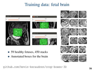 Training data: fetal brain
59 healthy fetuses, 450 stacks
Annotated boxes for the brain
github.com/kevin-keraudren/crop-boxes-3D 16
 
