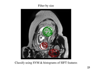 Filter by size
Classify using SVM & histograms of SIFT features
23
 