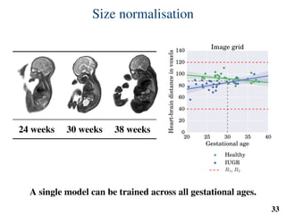 Size normalisation
24 weeks 30 weeks 38 weeks
20 25 30 35 40
Gestational age
0
20
40
60
80
100
120
140
Heart-braindistanceinvoxels
Image grid
Healthy
IUGR
R1, R2
A single model can be trained across all gestational ages.
33
 