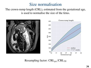 Size normalisation
The crown-rump length (CRL), estimated from the gestational age,
is used to normalise the size of the fetus.
CRLCRL
12 17 22 27 32 37 42
Gestational age
50
100
150
200
250
300
350
400
450
mm
Crown-rump length
median
5th
/ 95th
centile
Resampling factor: CRLga/CRL30
34
 