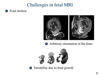 Challenges in fetal MRI
1 Fetal motion
2 Arbitrary orientation of the fetus
3 Variability due to fetal growth
5
 