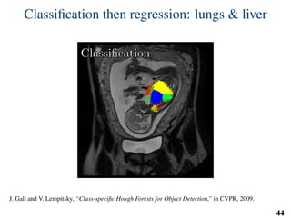 Classiﬁcation then regression: lungs & liver
ClassiﬁcationClassiﬁcation
J. Gall and V. Lempitsky, “Class-speciﬁc Hough Forests for Object Detection,” in CVPR, 2009.
44
 