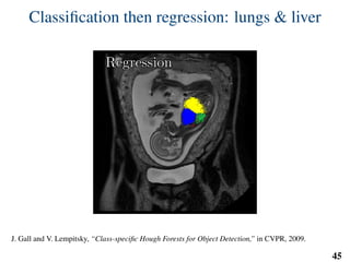 Classiﬁcation then regression: lungs & liver
RegressionRegression
J. Gall and V. Lempitsky, “Class-speciﬁc Hough Forests for Object Detection,” in CVPR, 2009.
45
 