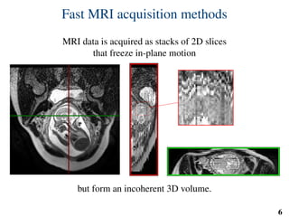 Fast MRI acquisition methods
MRI data is acquired as stacks of 2D slices
that freeze in-plane motion
but form an incoherent 3D volume.
6
 