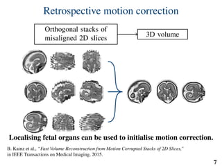 Retrospective motion correction
Orthogonal stacks of
misaligned 2D slices
3D volume
Localising fetal organs can be used to initialise motion correction.
B. Kainz et al., “Fast Volume Reconstruction from Motion Corrupted Stacks of 2D Slices,”
in IEEE Transactions on Medical Imaging, 2015.
7
 