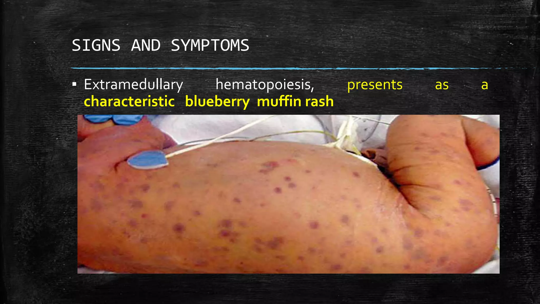 CONGENITAL RUBELLA SYNDROME | PPTX