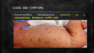 Congenital Rubella Syndrome Blueberry Muffin Rash