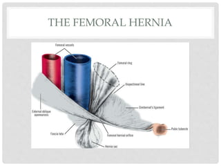THE FEMORAL HERNIA
 
