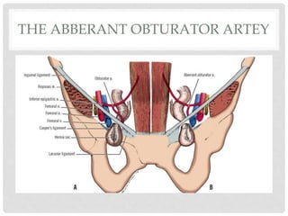 THE ABBERANT OBTURATOR ARTEY
 