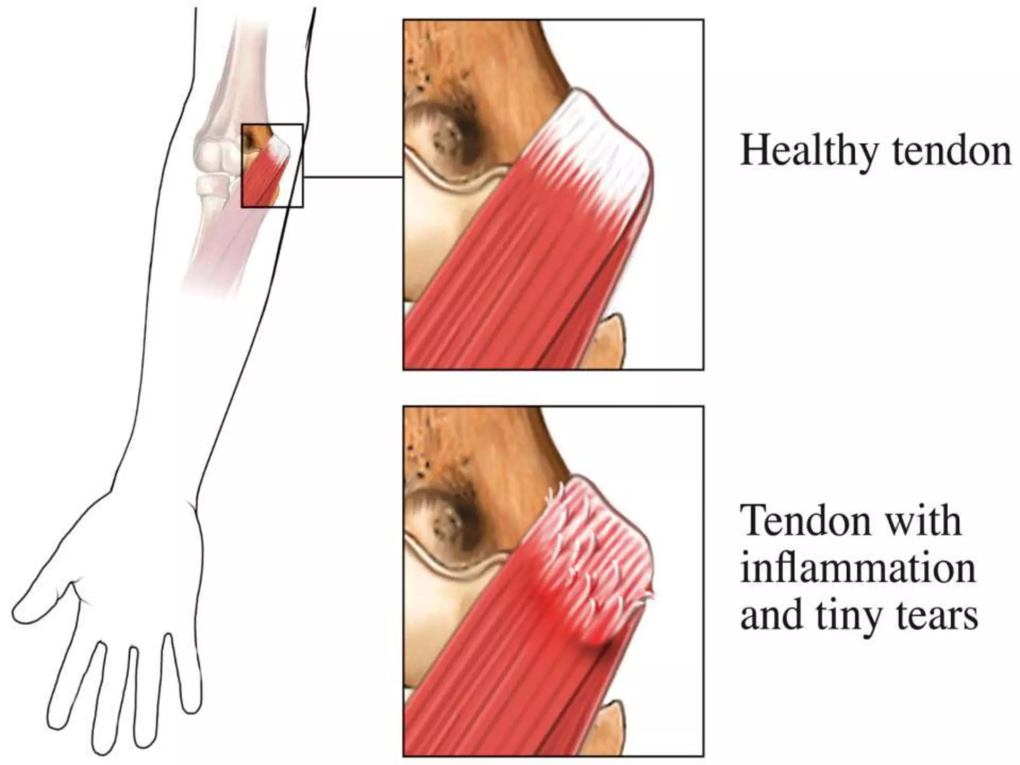 lateral & medial epicondylitis | PPTX