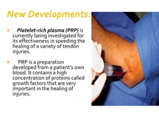  Platelet-rich plasma (PRP) is
currently being investigated for
its effectiveness in speeding the
healing of a variety of tendon
injuries.
 PRP is a preparation
developed from a patient's own
blood. It contains a high
concentration of proteins called
growth factors that are very
important in the healing of
injuries.
 