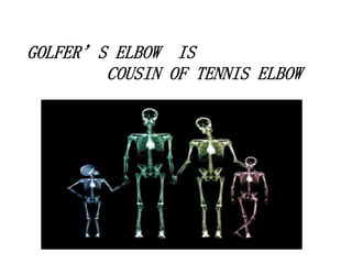 GOLFER’S ELBOW IS
COUSIN OF TENNIS ELBOW
 