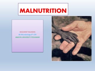 MALNUTRITION
BASHARAT NAUMAN
BS Microbiology 6th STR
ABASYN UNIVERSITY PESHAWAR
 