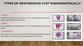 TYPES OF DENTIGEROUS CYST RADIOGRAPHICALLY
• Central :
in which the radiolucency surrounds just the crown of the tooth, with the
crown projecting into the cyst lumen.
• Lateral :
the cyst develops laterally along the tooth root and partially surrounds the
crown.
• Circumferential :
exists when the cyst surrounds the crown but also extends down along the
root surface, as if the entire tooth were located within the cyst.
 