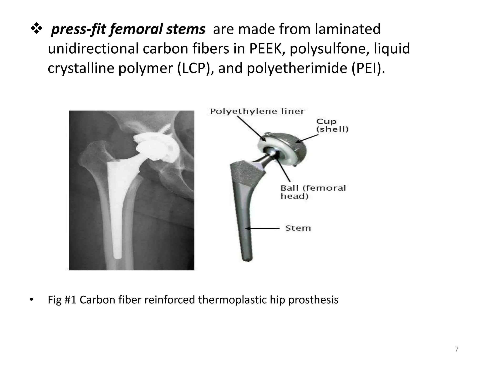  press-fit femoral stems are made from laminated
unidirectional carbon fibers in PEEK, polysulfone, liquid
crystalline polymer (LCP), and polyetherimide (PEI).
• Fig #1 Carbon fiber reinforced thermoplastic hip prosthesis
7
 