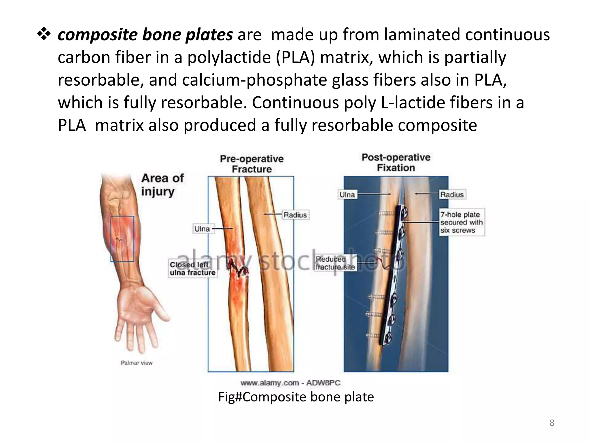  composite bone plates are made up from laminated continuous
carbon fiber in a polylactide (PLA) matrix, which is partially
resorbable, and calcium-phosphate glass fibers also in PLA,
which is fully resorbable. Continuous poly L-lactide fibers in a
PLA matrix also produced a fully resorbable composite
Fig#Composite bone plate
8
 