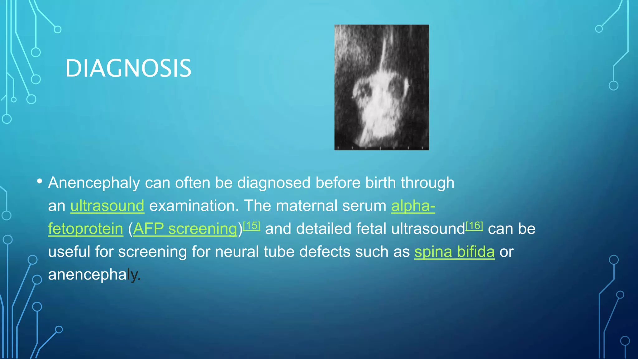 Congenital Abnormalities neuro | PPTX