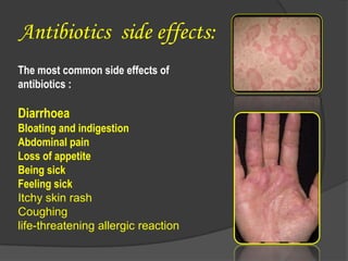 Antibiotics side effects:
The most common side effects of
antibiotics :
Diarrhoea
Bloating and indigestion
Abdominal pain
Loss of appetite
Being sick
Feeling sick
Itchy skin rash
Coughing
life-threatening allergic reaction
 
