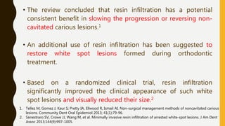 • The review concluded that resin infiltration has a potential
consistent benefit in slowing the progression or reversing non-
cavitated carious lesions.1
• An additional use of resin infiltration has been suggested to
restore white spot lesions formed during orthodontic
treatment.
• Based on a randomized clinical trial, resin infiltration
significantly improved the clinical appearance of such white
spot lesions and visually reduced their size.2
1. Tellez M, Gomez J, Kaur S; Pretty IA, Ellwood R, Ismail AI. Non-surgical management methods of noncavitated carious
lesions. Community Dent Oral Epidemiol 2013; 41(1):79-96.
2. Senestraro SV, Crowe JJ, Wang M, et al. Minimally invasive resin infiltration of arrested white-spot lesions. J Am Dent
Assoc 2013;144(9):997-1005.
 
