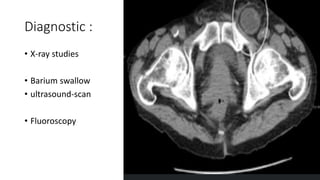 Diagnostic :
• X-ray studies
• Barium swallow
• ultrasound-scan
• Fluoroscopy
 