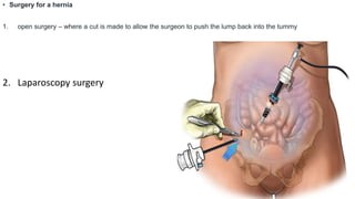 • Surgery for a hernia
1. open surgery – where a cut is made to allow the surgeon to push the lump back into the tummy
2. Laparoscopy surgery
 