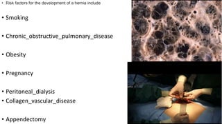 • Risk factors for the development of a hernia include
• Smoking
• Chronic_obstructive_pulmonary_disease
• Obesity
• Pregnancy
• Peritoneal_dialysis
• Collagen_vascular_disease
• Appendectomy
 