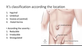 It’s classification according the location
1. Inguinal
2. Umbilical
3. Incesio al (ventral)
4. -hiatal-hernia
• According the severity :
1. Reducible
2. Irreducible
3. Strangulated
 