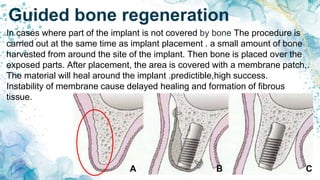 Guided bone regeneration
In cases where part of the implant is not covered by bone The procedure is
carried out at the same time as implant placement . a small amount of bone
harvested from around the site of the implant. Then bone is placed over the
exposed parts. After placement, the area is covered with a membrane patch,.
The material will heal around the implant .predictible,high success.
Instability of membrane cause delayed healing and formation of fibrous
tissue.
A B C
 