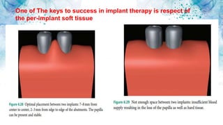 One of The keys to success in implant therapy is respect of
the per-implant soft tissue
 